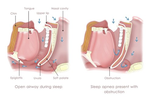 description of sleep apnea